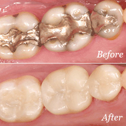 How Fillings Restoration Can Save Your Teeth?