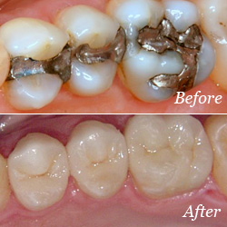 Dental Crown Baltimore MD, Crowns Teeth, Porcelain Crowns